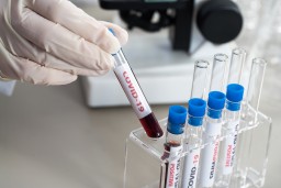 Риск длительного течения COVID-19 научились определять по крови
