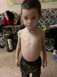 Полицейские начали расследование в отношении родителей истощенного 5-летнего малыша из Кокшетау