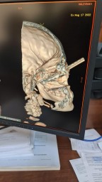 Акмолинские врачи спасли ребёнка, вытащив проткнувший голову штырь